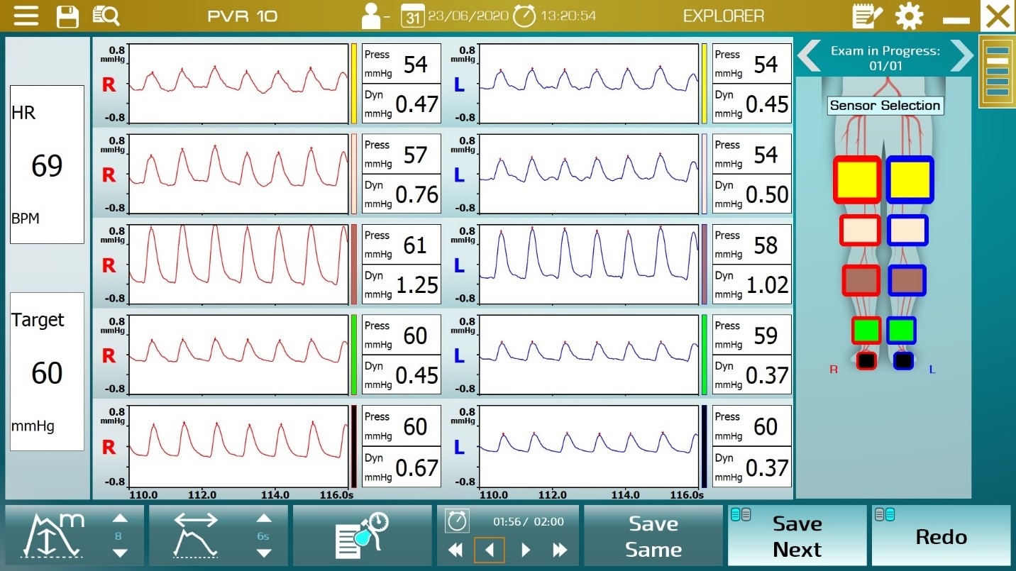 Simultaneous recording of 10 PVR curves