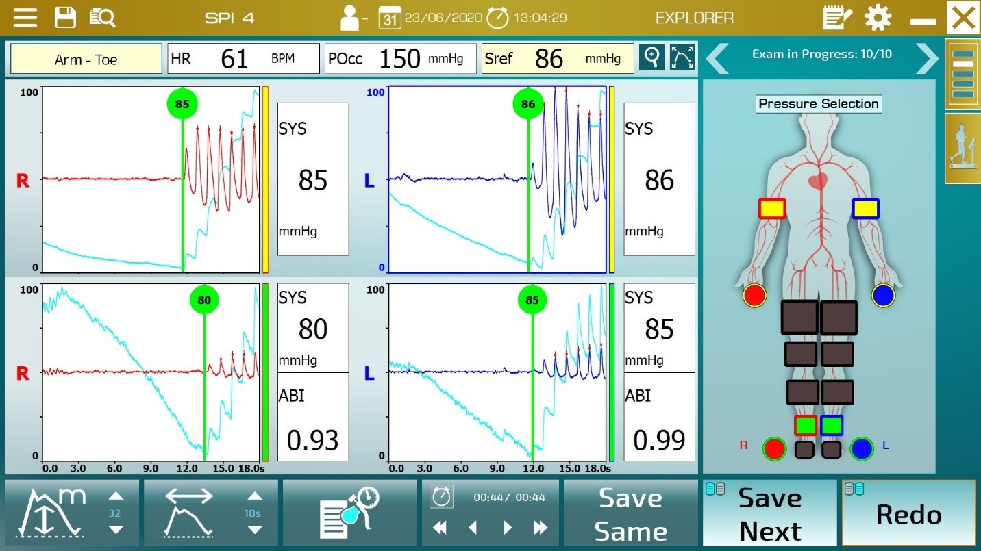 ABI-Ankle brachial index-Simultaneous measurement of both arm pressures and both toe pressure with PPG