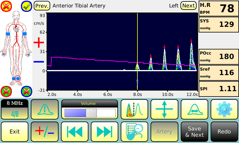 BASIC- measurement of ankle systolic pressure with Doppler