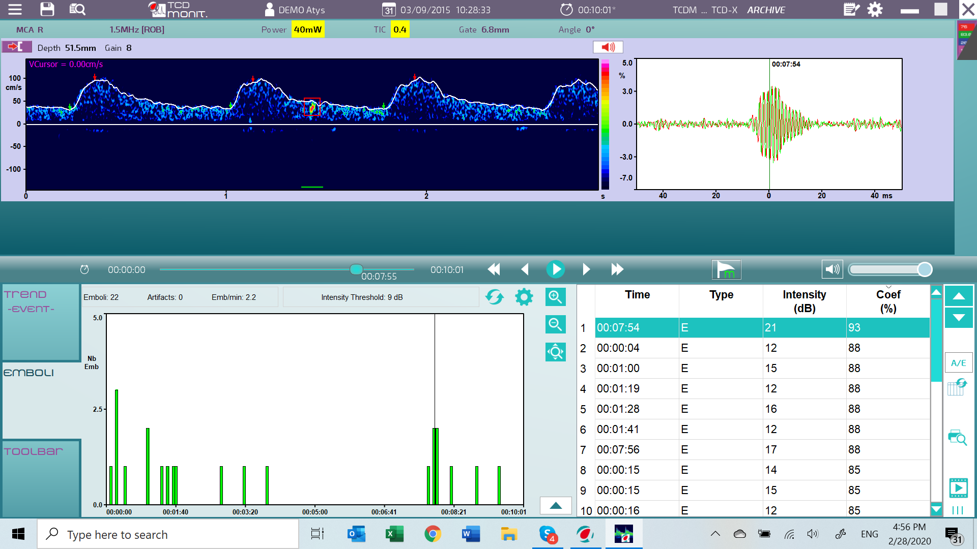 Atys medical transcranial Doppler advanced emboli detection