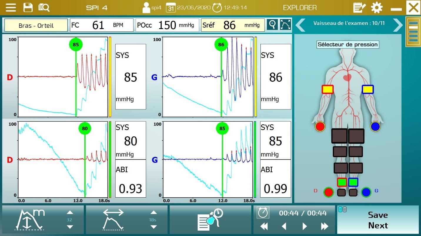 Simultaneous measurement of both arm pressures and both toe pressure with PPG
