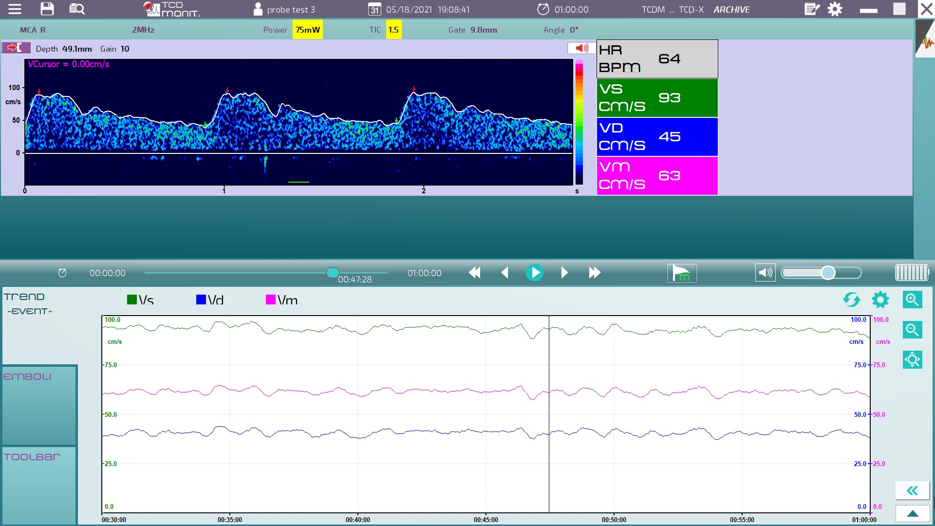 Atys medical transcranial Doppler monitoring