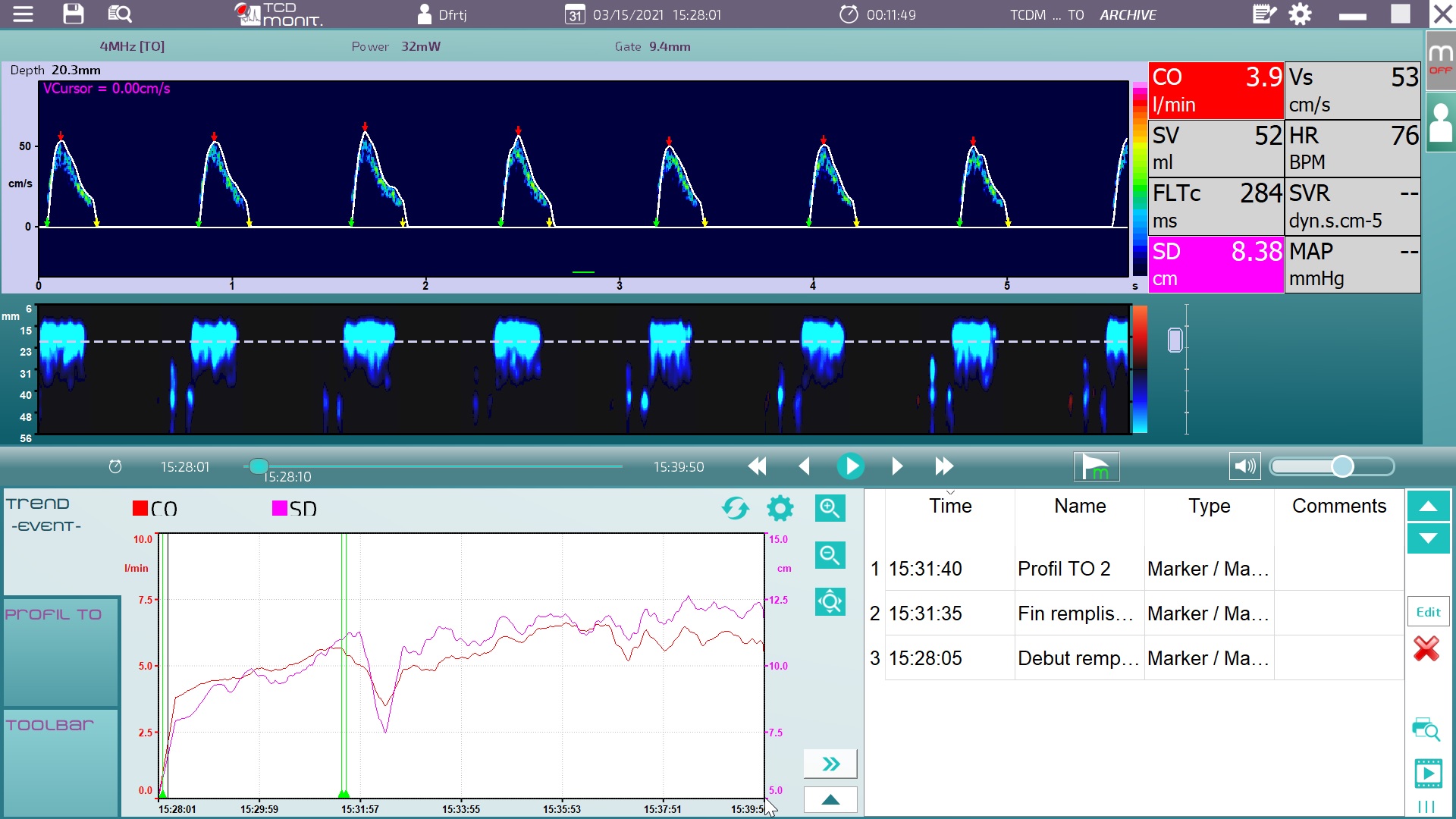 fluid fliiling optimisation with esophageal Doppler cardiac output monitor