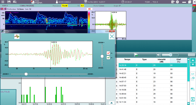 Atys TCD-X TCD détection d'emboles Stroke UMV