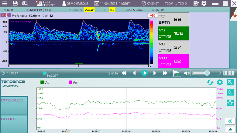 Atys medical TCD-X Doppler transcranien embole HITS