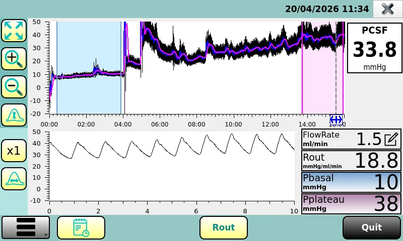 HydroScreen screen showing the CSF pressure curve, baseline and plateau zones and the calculated Rout