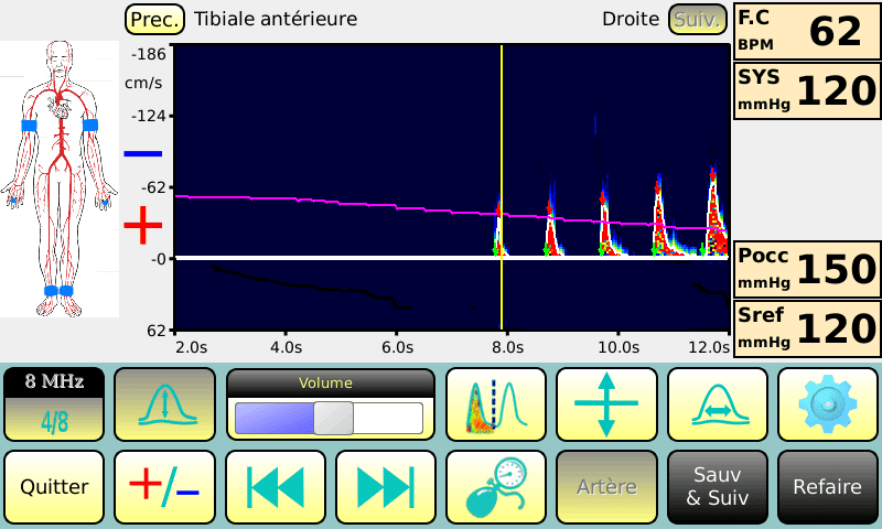 Pression systolique à la cheville avec le Doppler