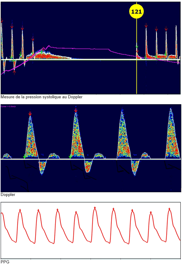 Pression systolique, Doppler continu, photopléthysmographie